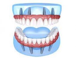 Full Mouth Dental Implants in Houston TX