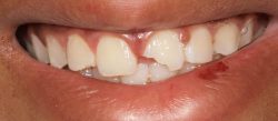 Laser Teeth Whitening Dentist in NYC