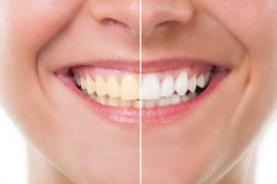 Laser Teeth Whitening Before And After Process