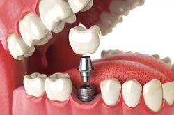 All On 4 Dental Implants in Aventura | Sunny Dental provides