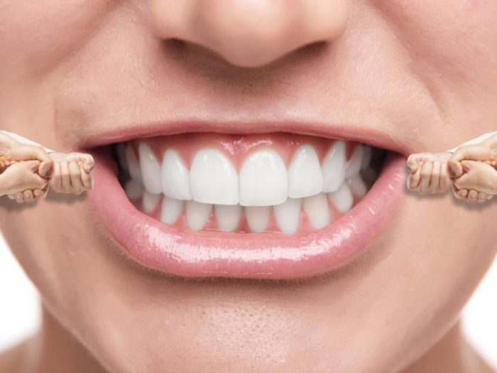 Miami Beach Teeth Whitening Treatment | Best dental Design Smile miami