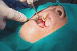 Best Dental Implant Specialist