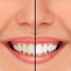 Laminate Veneers For Stained Teeth