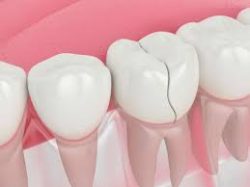 Porcelain Veneers For Crooked Teeth | Dental Veneers For Cracked Tooth