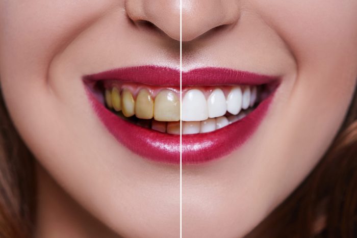 Dental Veneer Before And After