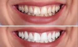 Laser Dentistry Near me | Laser Teeth Whitening NYC