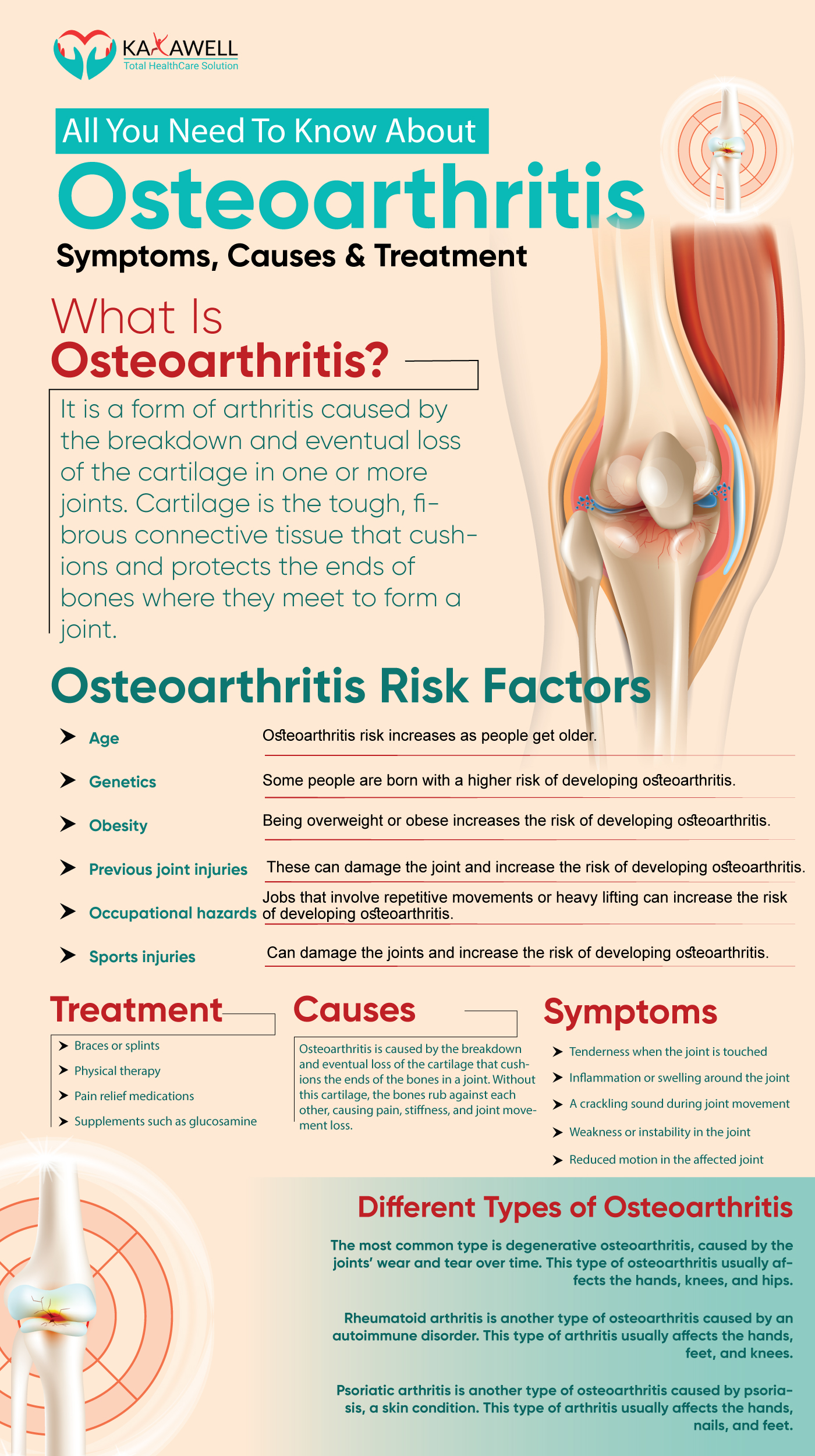 Osteoarthritis Treatment, Symptoms, Signs & Causes - Social Social ...