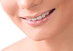 Invisible Teeth Braces for Adults | Clear Aligners