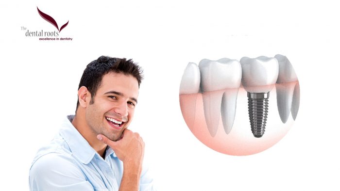 Best Services For Dental Implants in Delhi
