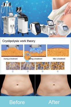 How effective is Cryolipolysis for weight loss