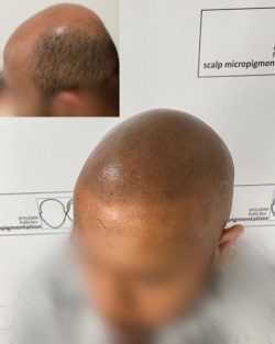 Get the Best Treatment for Male Pattern Hair Loss