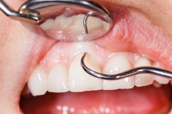Laser Dentistry For Gum Disease | laser dentistry