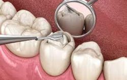 Dental Crown Procedure Cost | How To Fix a Broken Dental Crown?