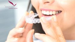 Invisalign Treatment in Delhi | TheDentalRoots