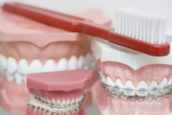 North Miami Beach Orthodontics | Orthodontist for Invisalign and Braces