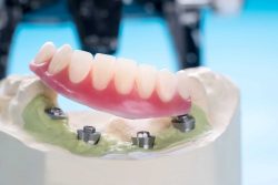 All On 4 Dental Implants Houston TX | Implant and Cosmetic Dentistry