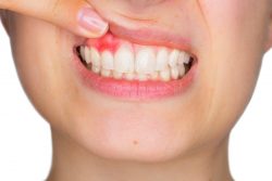 Gum Disease Treatment Specialist