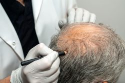 Scalp Micropigmentation Treatment For Bald Scalp | Hair Loss Treatment