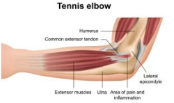 Έξω Επικονδυλίτιδα Αγκώνα – Tennis Elbow Θεραπεία