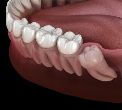 Wisdom Teeth Removal | Dental Clinic in Houston, TX
