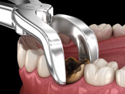 Wisdom Teeth Removal Houston,TX | Affordable Dental Clinics