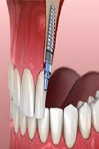 Best Cosmetic Dental Implants