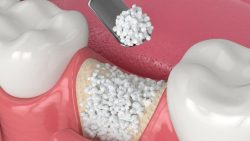 Periodontal Disease Treatment | Dental Clinic in Uptown Houston | Find a Dentist – Delta D ...