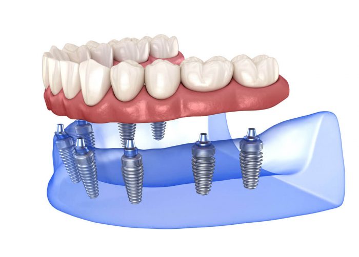 Different Types of Dental Implants | Implant Types