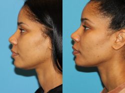  Neck Lift Cosmetic Surgery