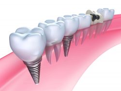 Dental Implants in North Miami | Dental Implants Specialist