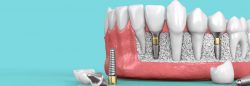 Dental Implants Service | Tooth Implant