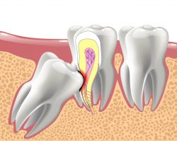 Emergency Tooth Extraction In Houston,TX | Dental Emergency Surgery
