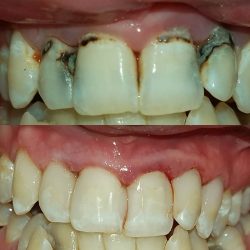 Composite Front Tooth Cavity Filling or Bonding