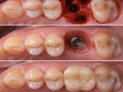 Advantages of Same-Day Dental Implants | Pros and cons of same-day dental implants