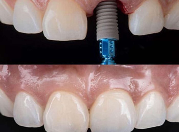 Affordable Dental Implants Near Me | Teeth Implants