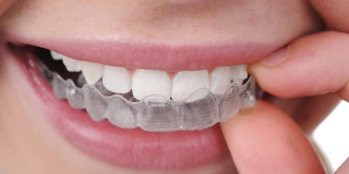 ClearCorrect Aligners | Clear Teeth Aligners In Houston
