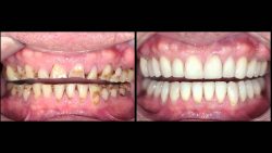 Teeth Bonding Near Me | Teeth Restoration in Houston