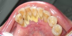 Periodontal Scaling And Root Planing | Deep-Cleaning Treatments