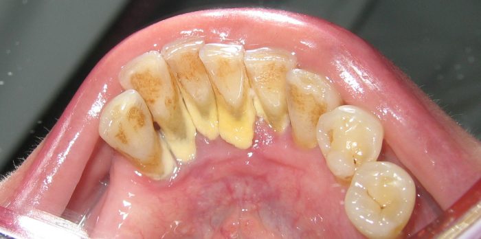 Periodontal Scaling And Root Planing | Deep-Cleaning Treatments