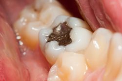 Fix Chipped & Broken Tooth Filling | How to fix half broken teeth