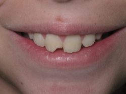 Repair Cracked or Broken Teeth | Fix Chipped & Broken Tooth Filling