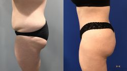 Before and After Picture of Brazilian Butt Lift