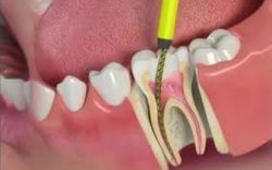 Root Canal Dentist Near Me | Doctors for Root Canal Treatment
