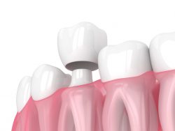 Best Dentist For Crowns Near Me | Same-Day Cosmetic Crowns
