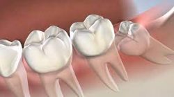 Wisdom Teeth Removal Near Me | Wisdom Teeth Extraction