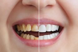 Teeth Bonding Before And After | Dental Bonding