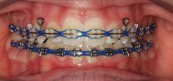 Choose the Best Colors for your Braces | How to Choose Colors for Braces