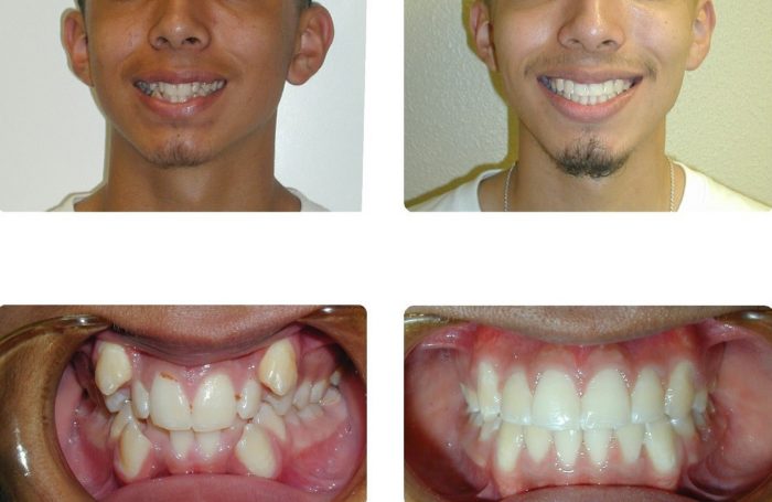 Overbite Before And After Braces | Orthodontic Before and After