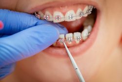Can You Get Braces with Missing Teeth? | Ortho with Missing Teeth