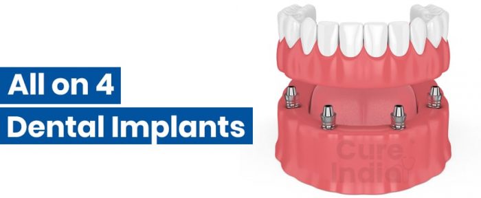 All on 4 dental implants cost